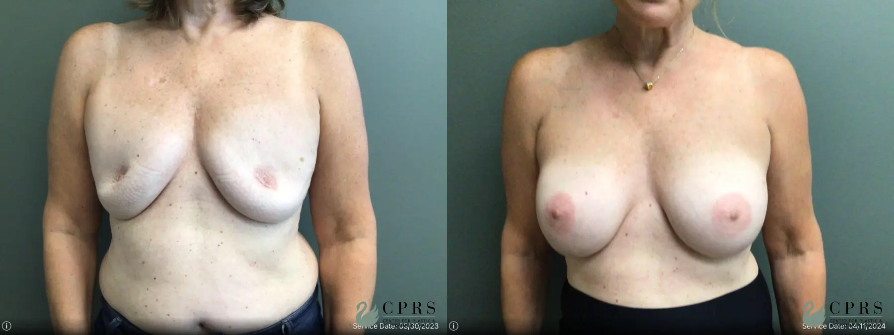 Breast Reconstruction: Patient 9 - Before and After  