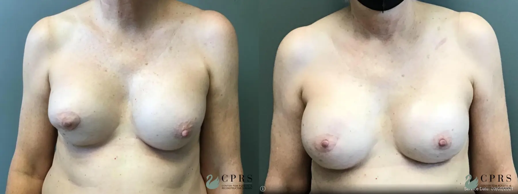 Breast Reconstruction: Patient 7 - Before and After 1