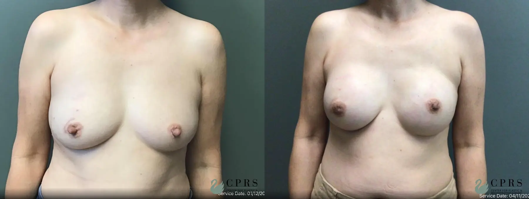 Breast Reconstruction: Patient 8 - Before and After  