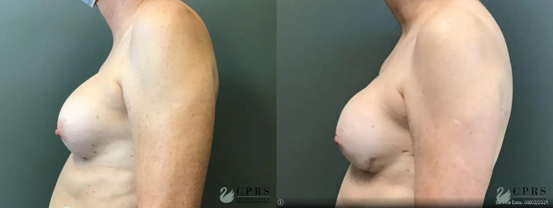 Breast Reconstruction: Patient 7 - Before and After 2