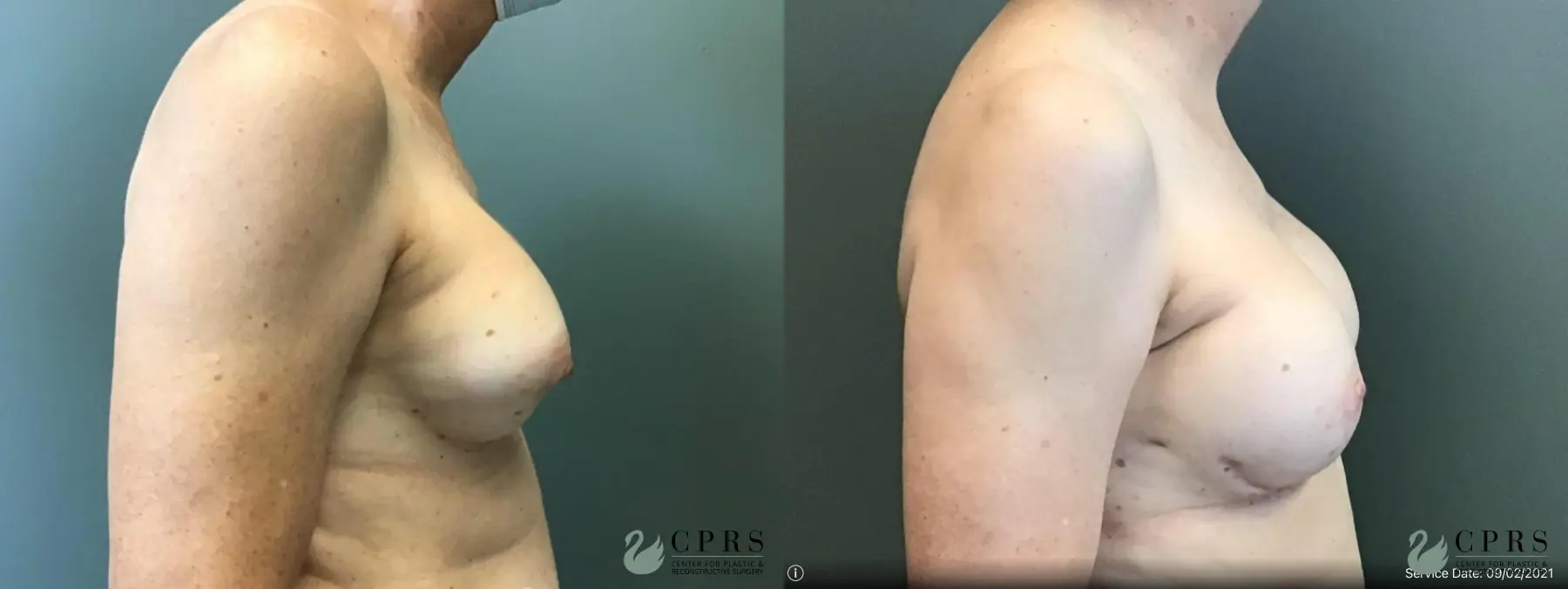 Breast Reconstruction: Patient 7 - Before and After 3