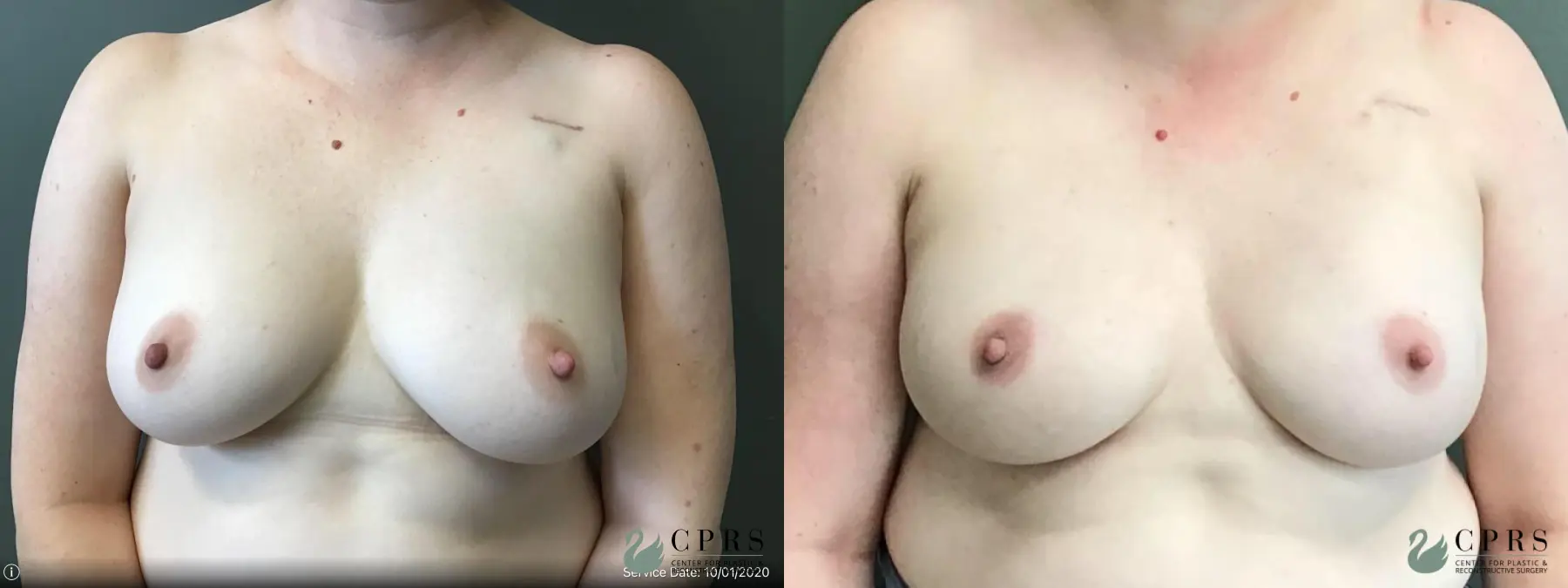 Breast Reconstruction: Patient 1 - Before and After  