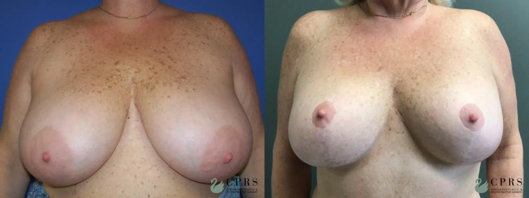 Breast Reduction: Patient 16 - Before and After  