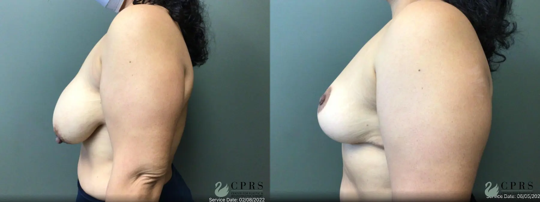 Breast Reduction: Patient 19 - Before and After 3