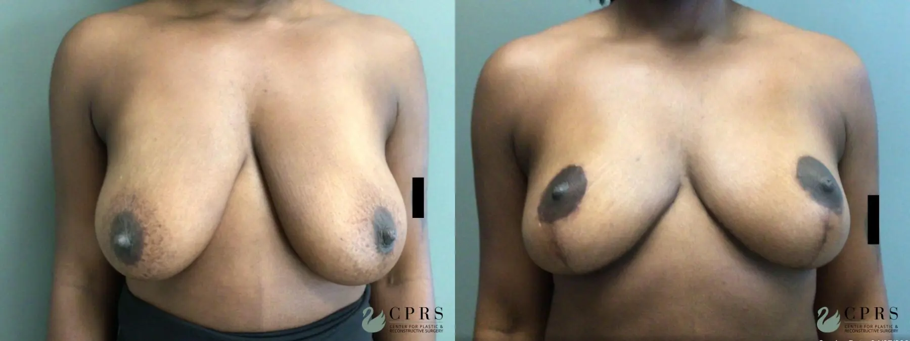 Breast Reduction: Patient 19 - Before and After  