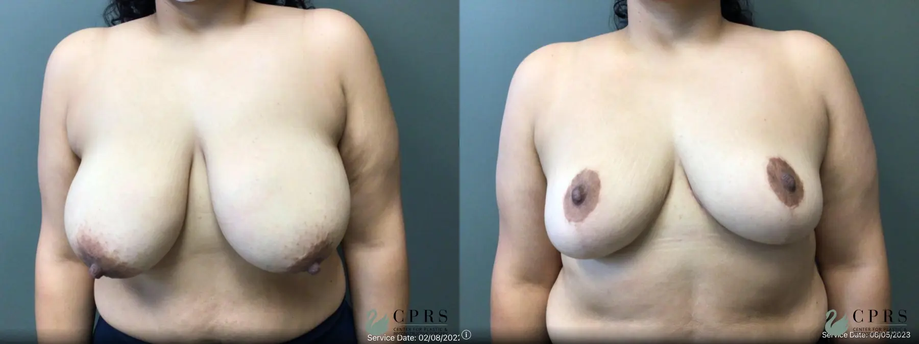 Breast Reduction: Patient 19 - Before and After 1