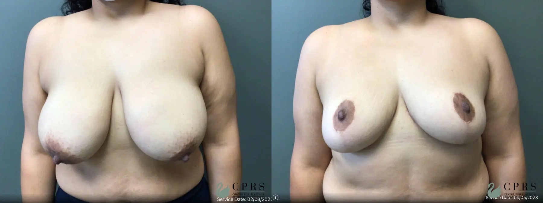 Breast Reduction: Patient 20 - Before and After  