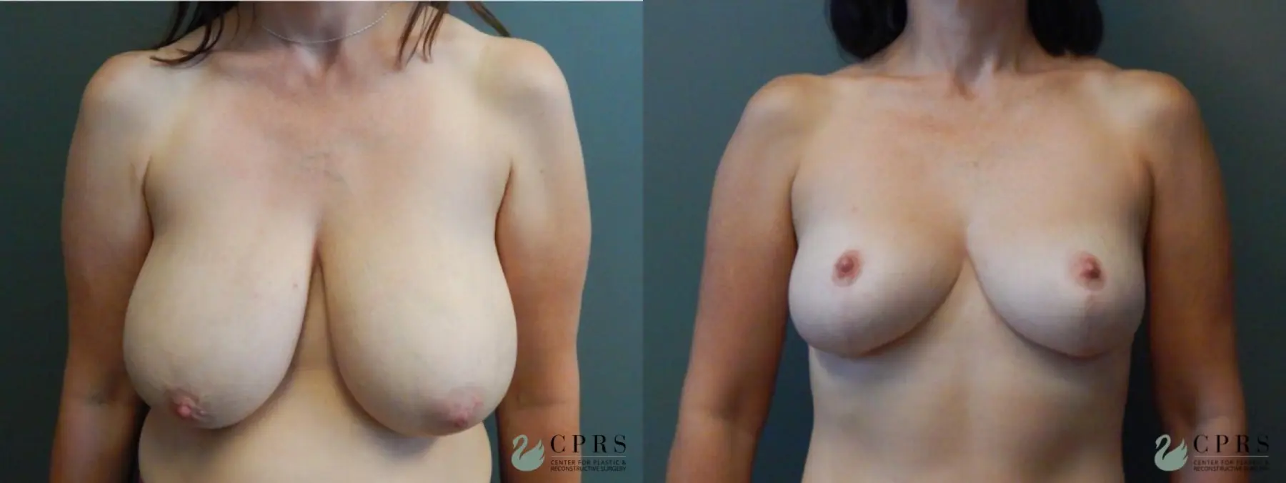 Breast Reduction: Patient 1 - Before and After  