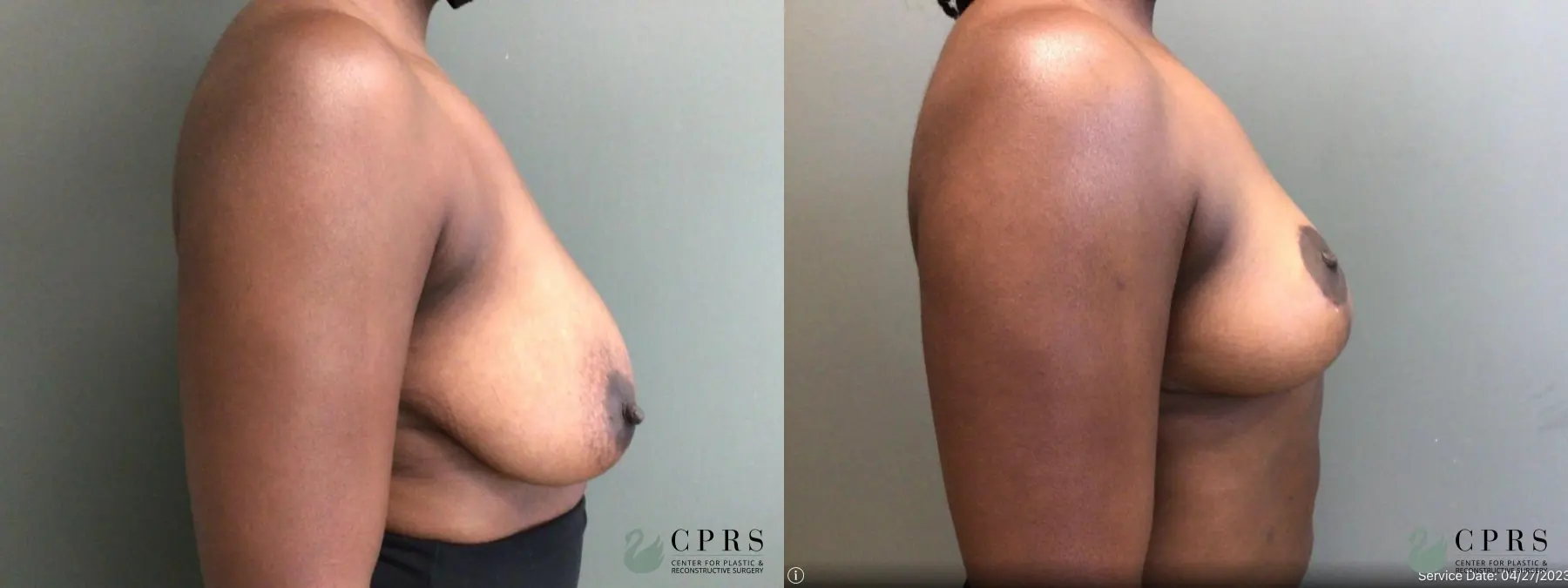 Breast Reduction: Patient 18 - Before and After 3