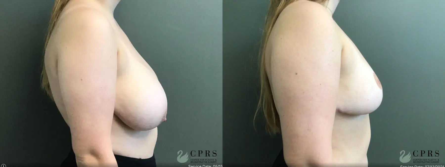 Breast Reduction: Patient 17 - Before and After 3
