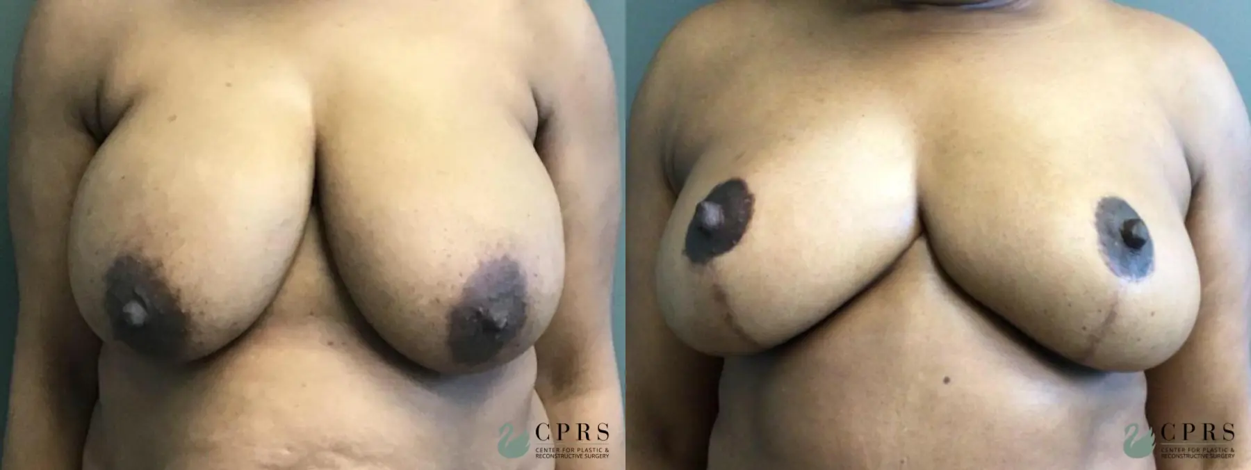 Breast Reduction: Patient 11 - Before and After  