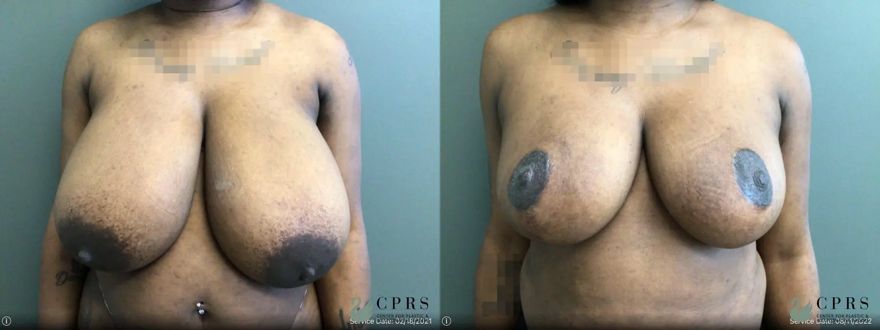 Breast Reduction: Patient 17 - Before and After  