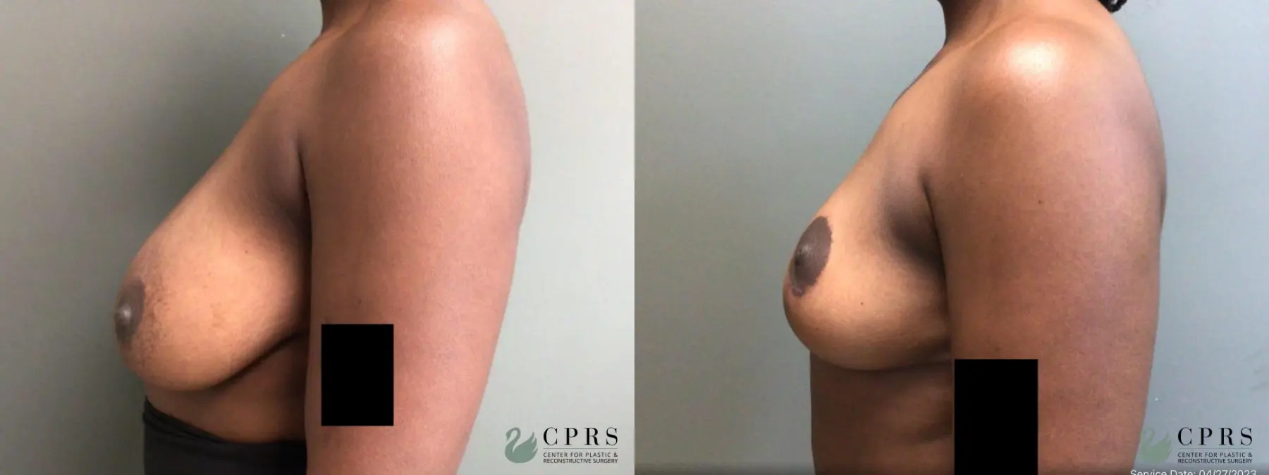 Breast Reduction: Patient 18 - Before and After 2