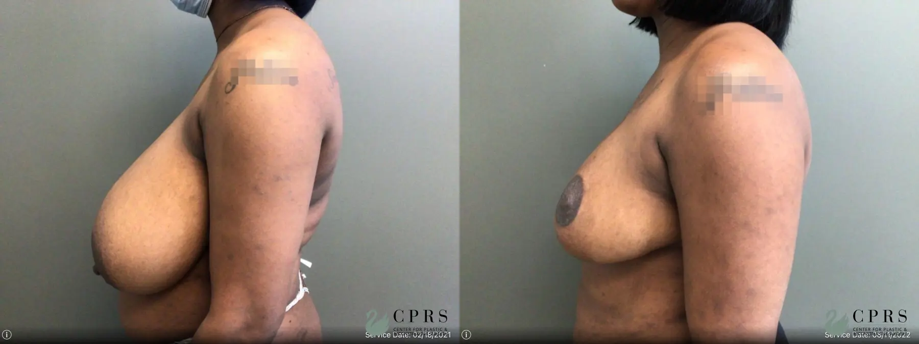 Breast Reduction: Patient 16 - Before and After 2