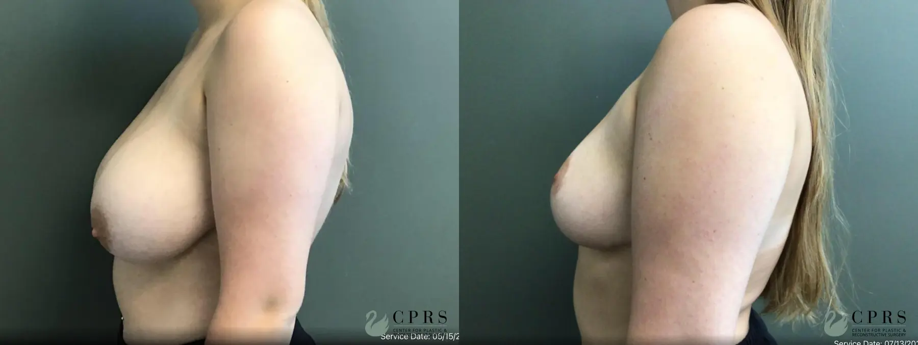 Breast Reduction: Patient 17 - Before and After 2