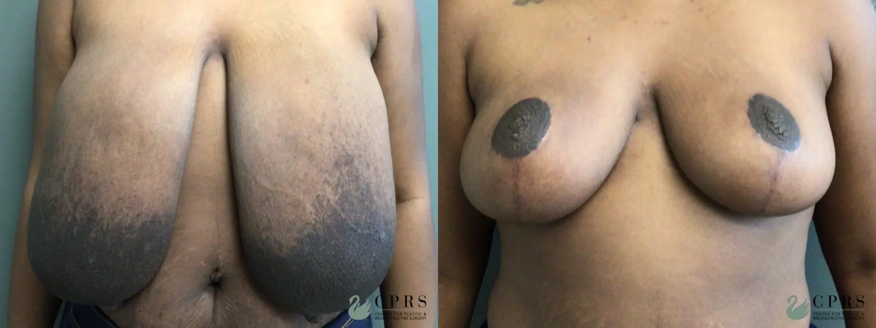 Breast Reduction: Patient 3 - Before and After  