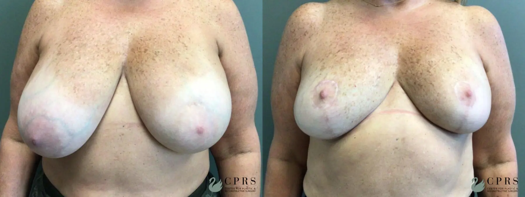 Breast Reduction: Patient 14 - Before and After  