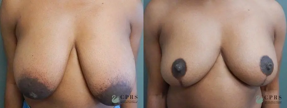 Breast Reduction: Patient 10 - Before and After  