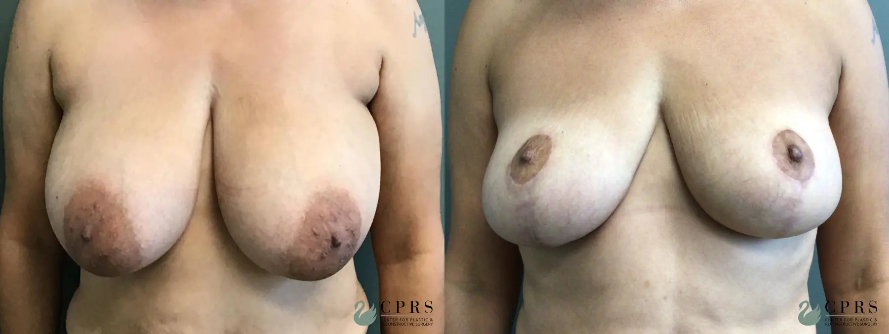 Breast Reduction: Patient 8 - Before and After  