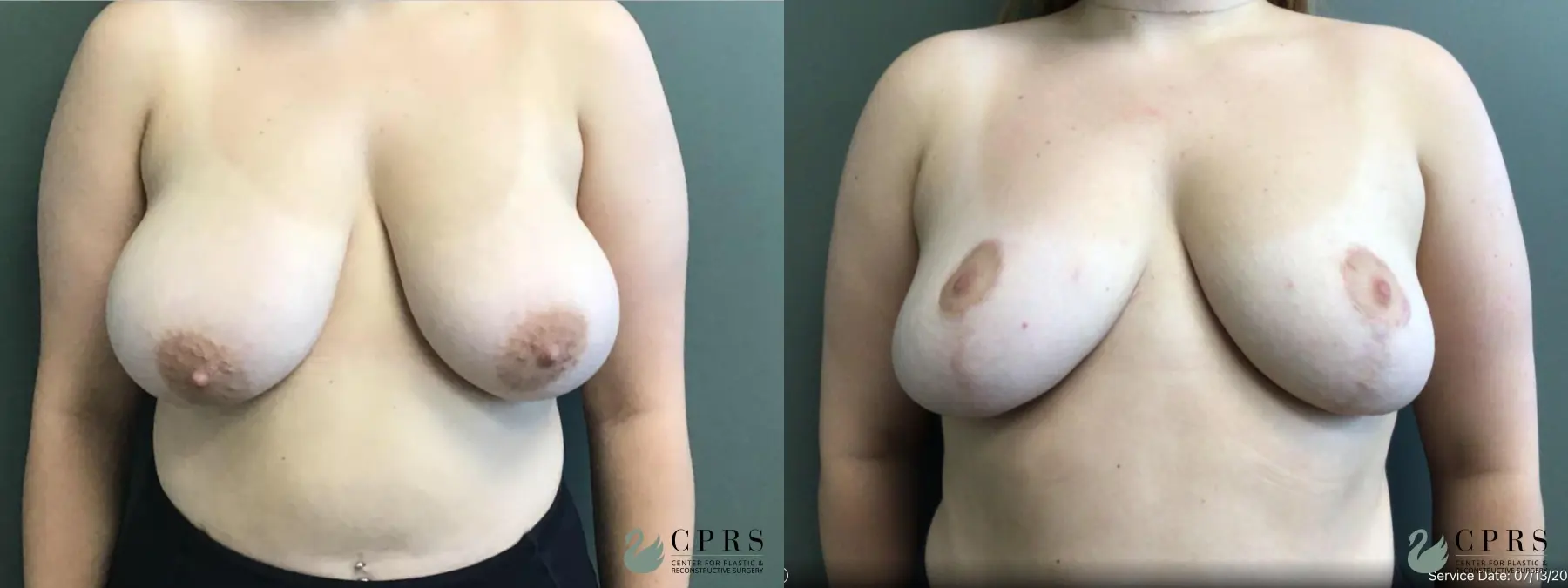 Breast Reduction: Patient 17 - Before and After 1