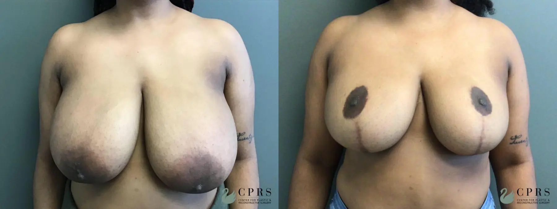 Breast Reduction: Patient 4 - Before and After  