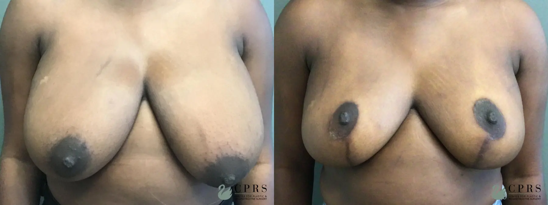 Breast Reduction: Patient 9 - Before and After  