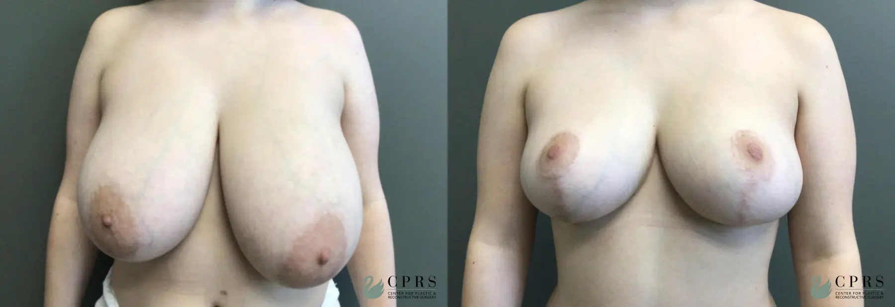 Breast Reduction: Patient 2 - Before and After  