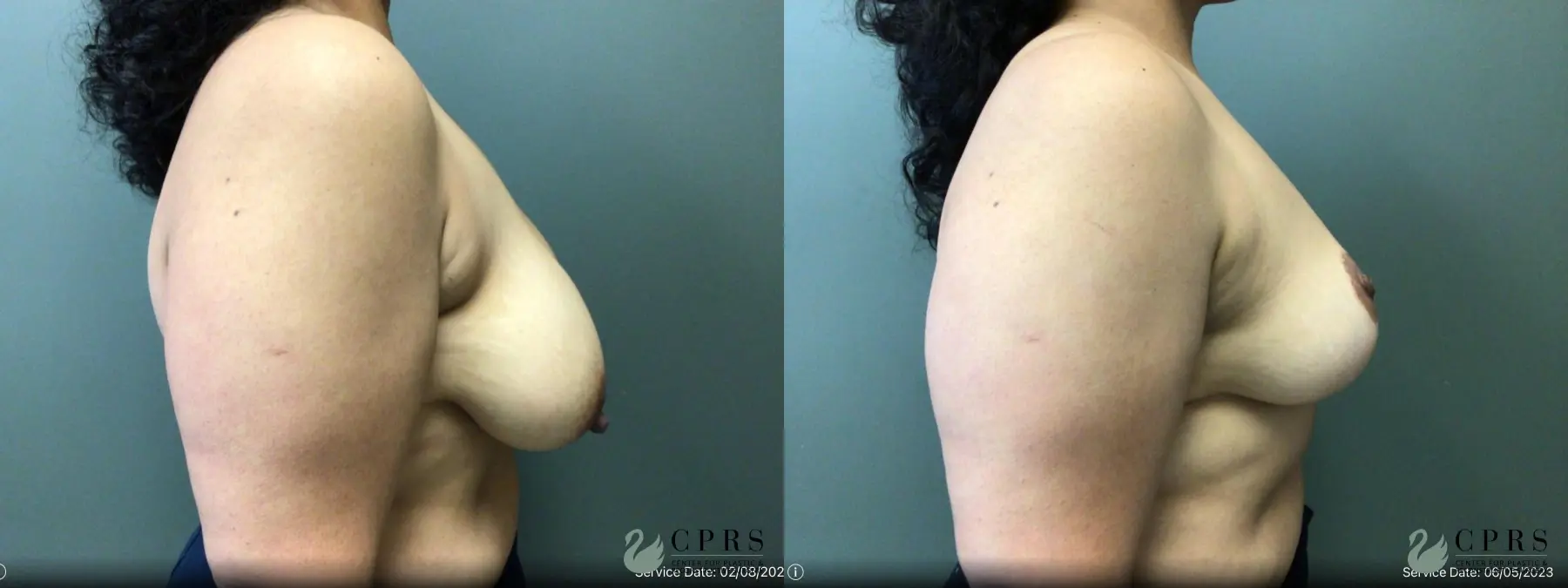 Breast Reduction: Patient 19 - Before and After 2