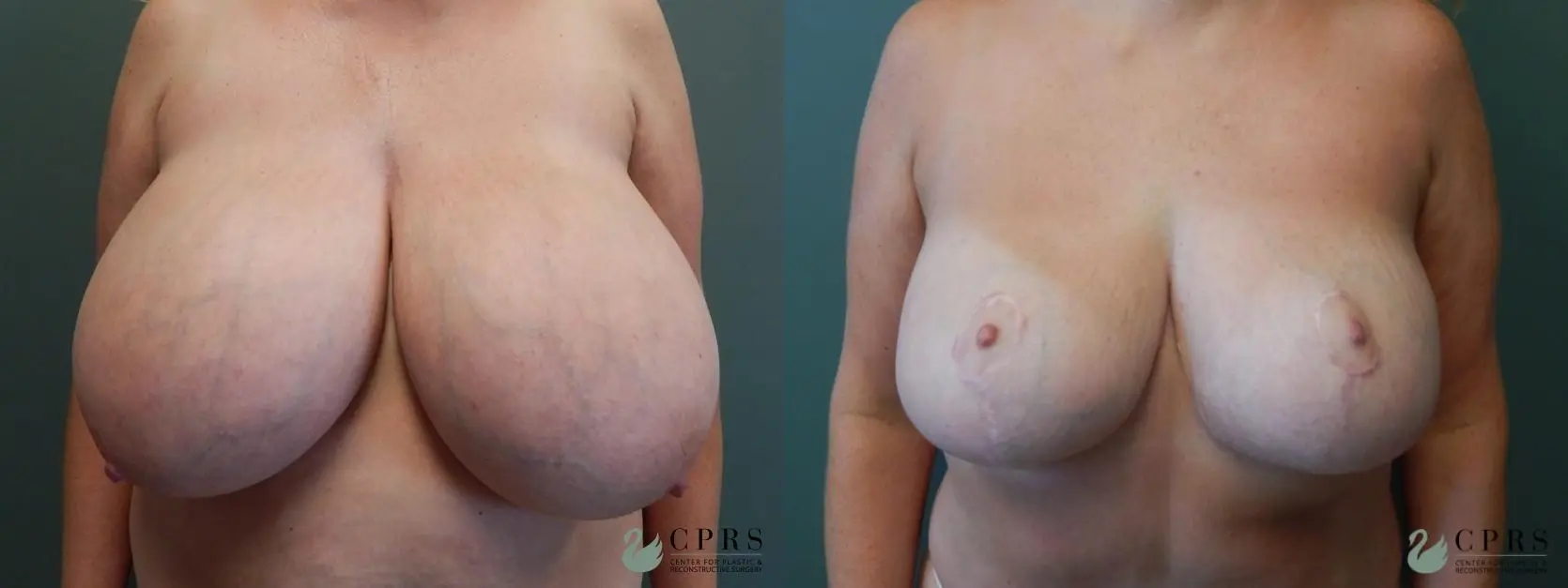 Breast Reduction: Patient 6 - Before and After  