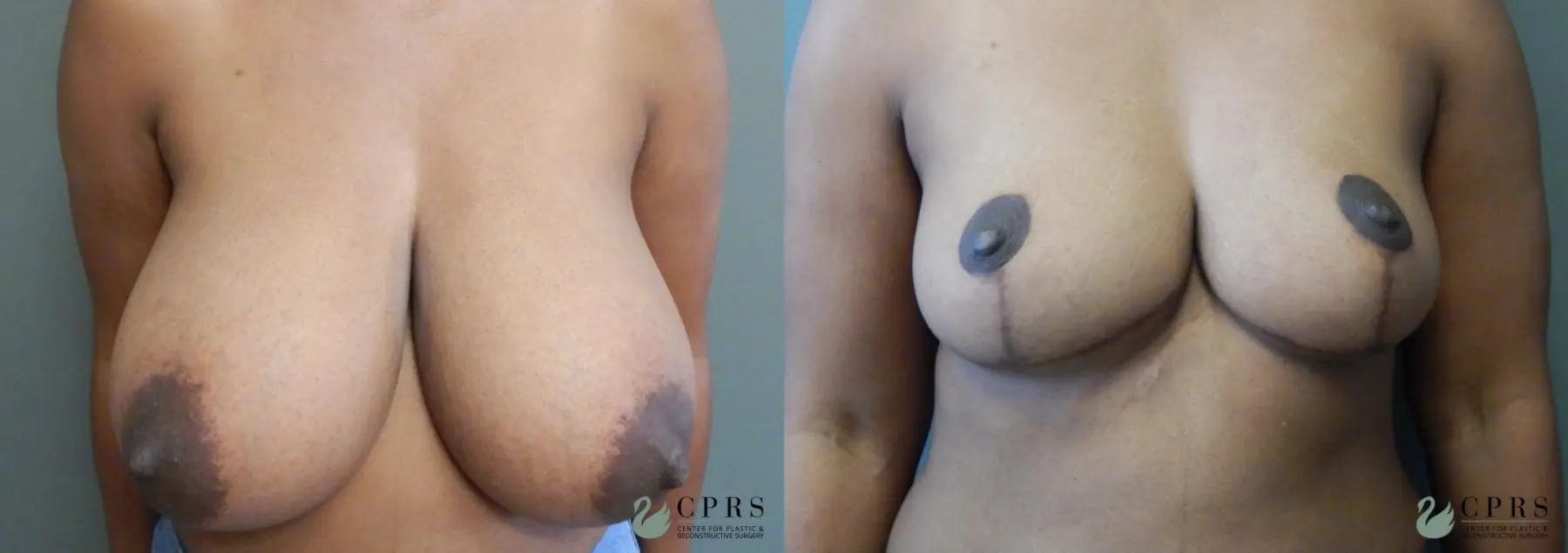 Breast Reduction: Patient 13 - Before and After  