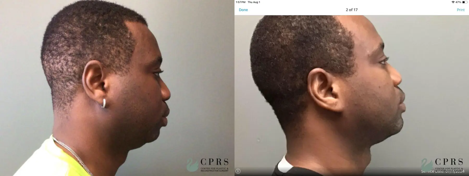 Chin Augmentation: Patient 5 - Before and After  