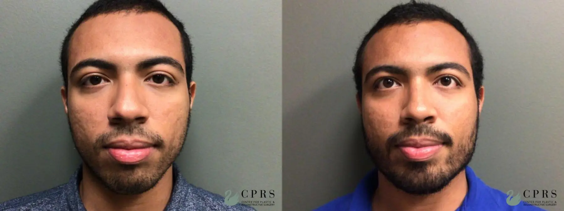 Chin Augmentation: Patient 4 - Before and After  