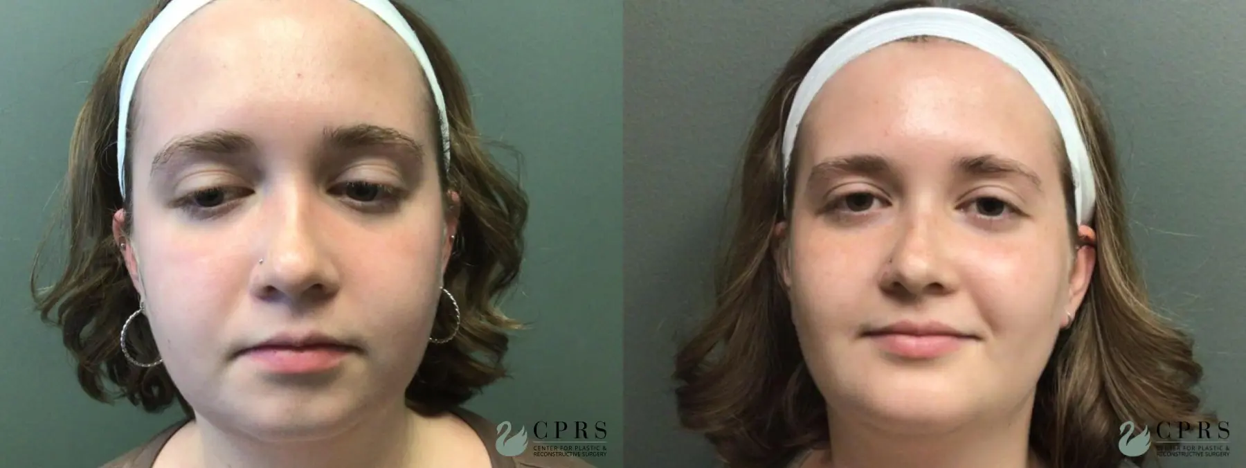 Chin Augmentation: Patient 3 - Before and After  