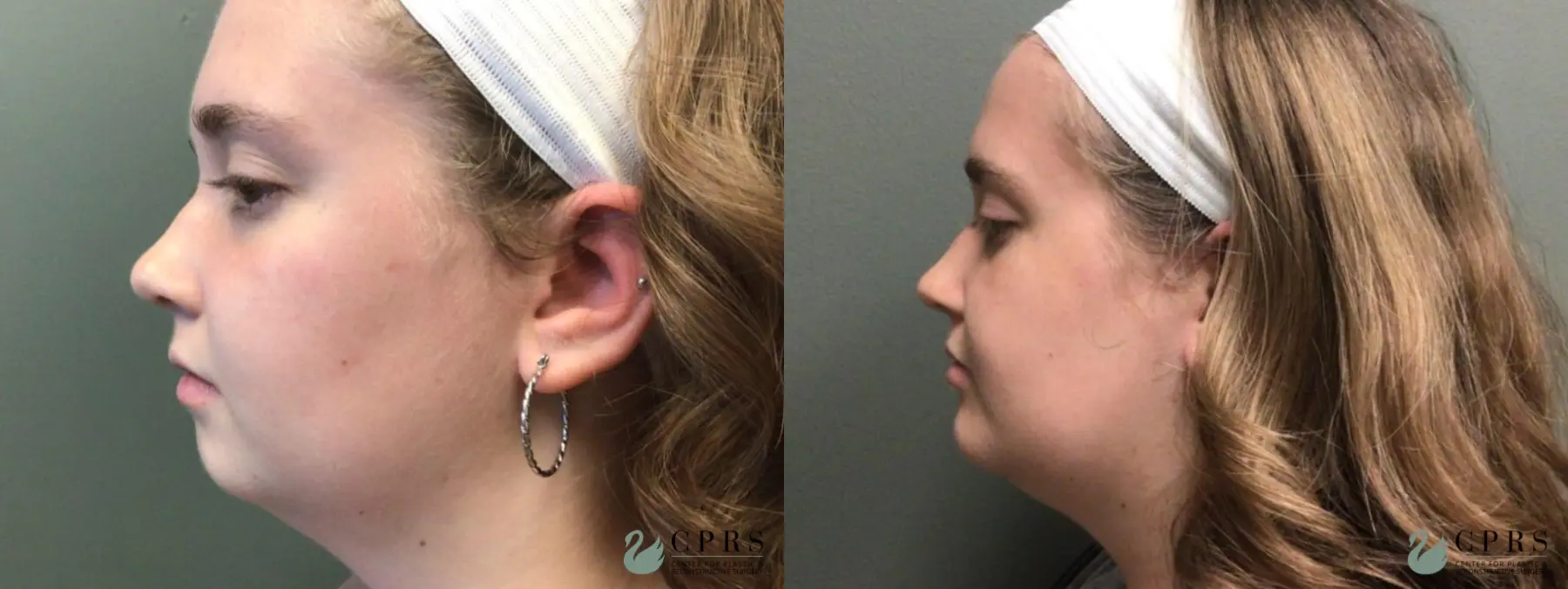 Chin Augmentation: Patient 3 - Before and After 3