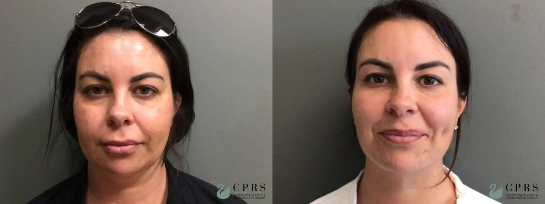 Chin Augmentation: Patient 2 - Before and After  