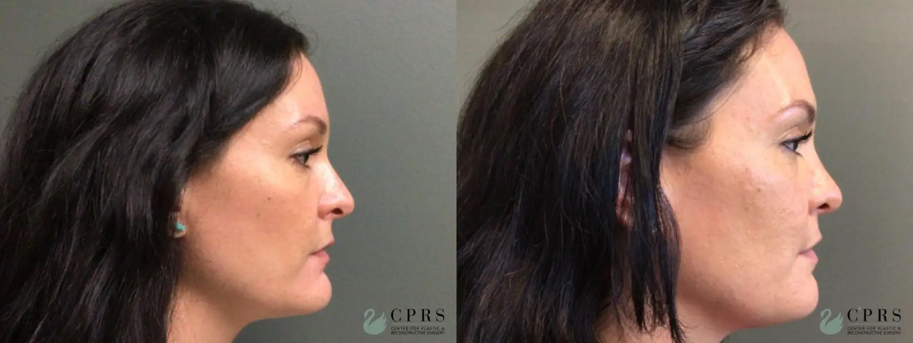 Chin Reduction: Patient 1 - Before and After 2