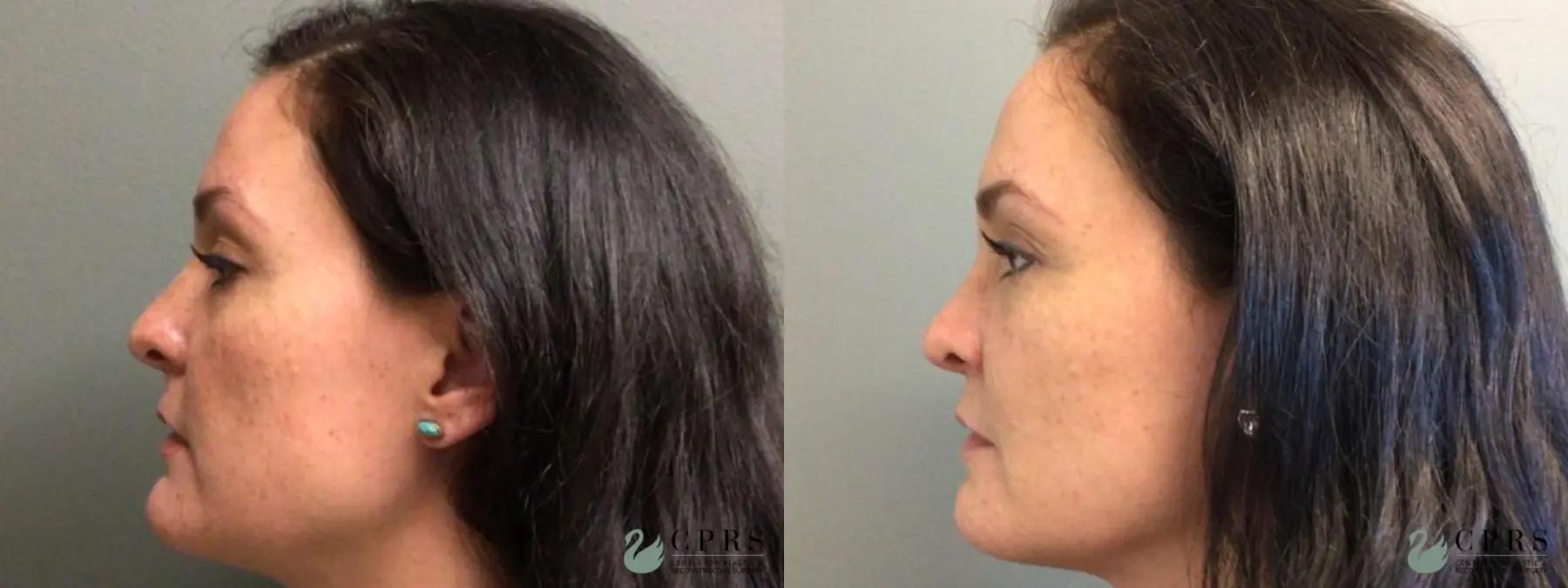 Chin Reduction: Patient 1 - Before and After 1
