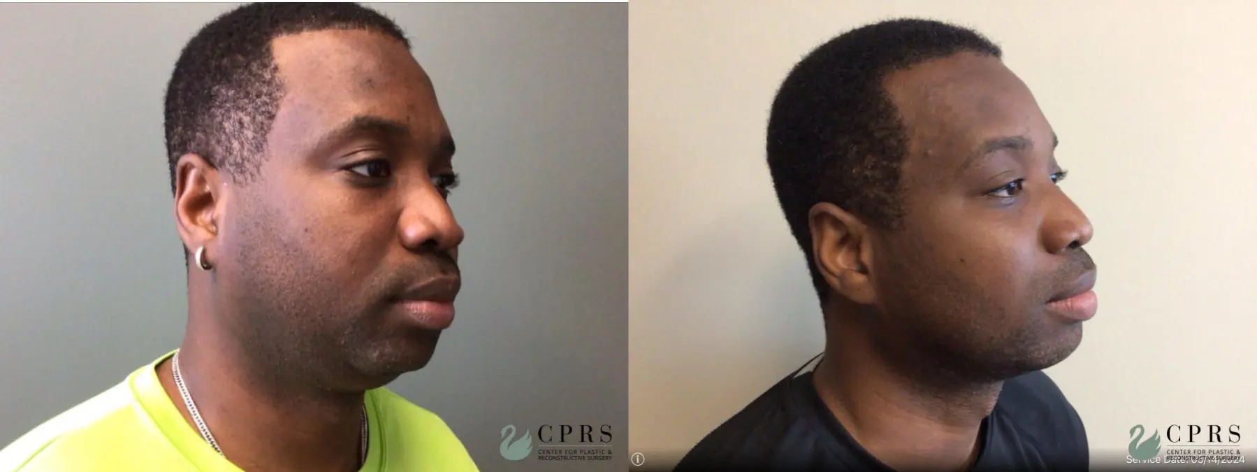 Chin Reduction: Patient 2 - Before and After  