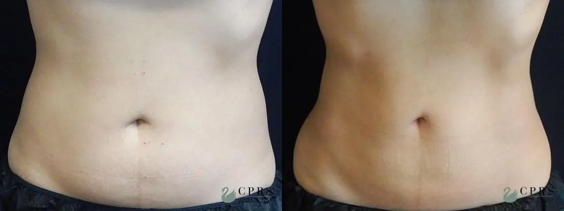 CoolSculpting®: Patient 2 - Before and After  