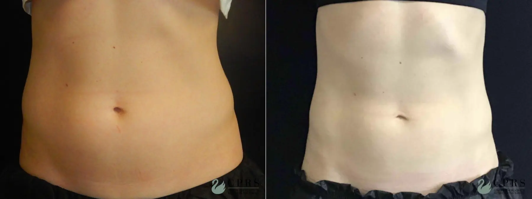 CoolSculpting®: Patient 5 - Before and After  