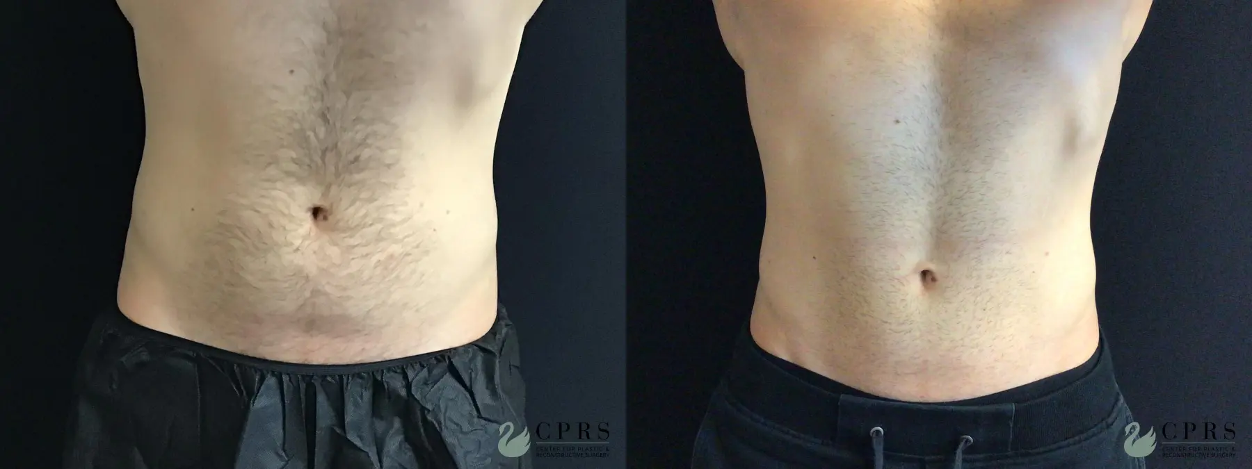 CoolSculpting®: Patient 3 - Before and After  