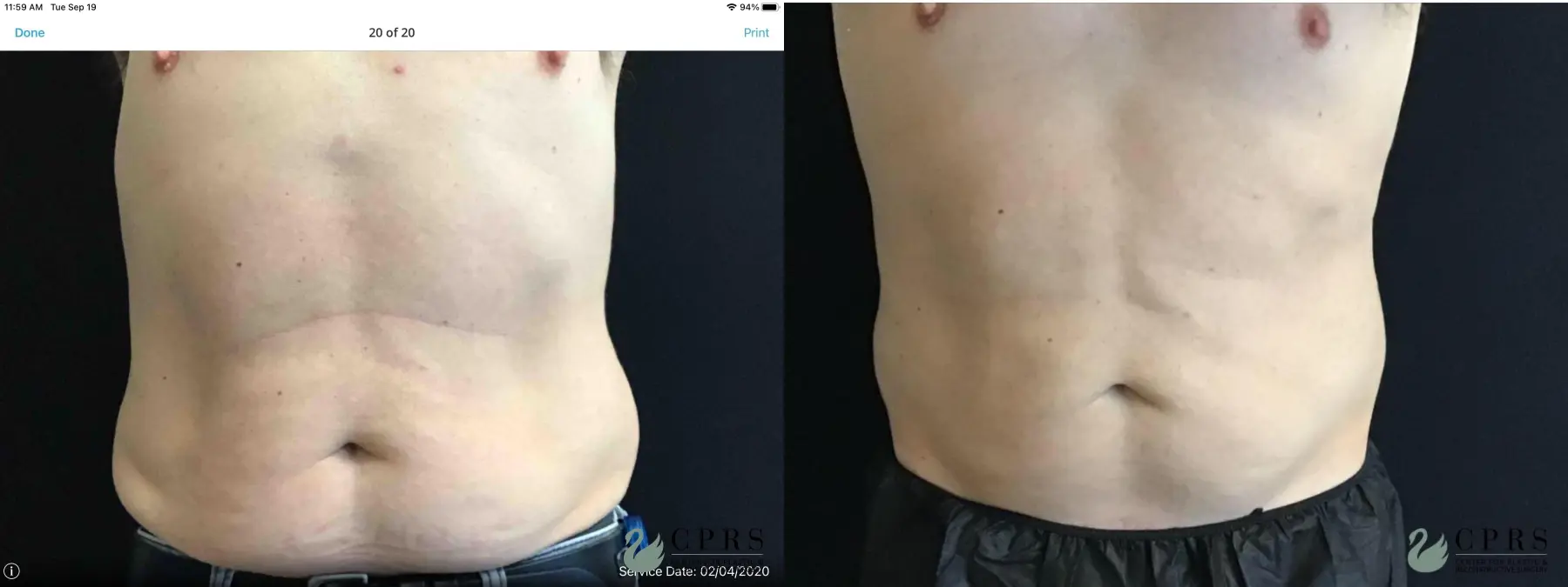 CoolSculpting®: Patient 7 - Before and After 1