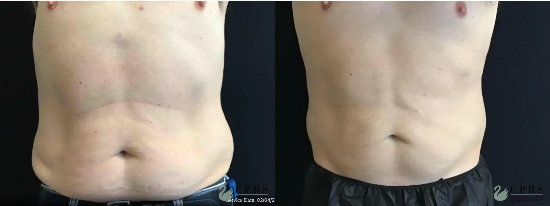 CoolSculpting®: Patient 7 - Before and After  