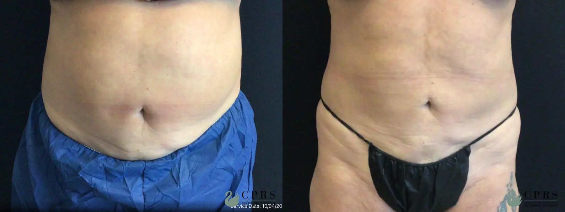 CoolSculpting®: Patient 4 - Before and After  