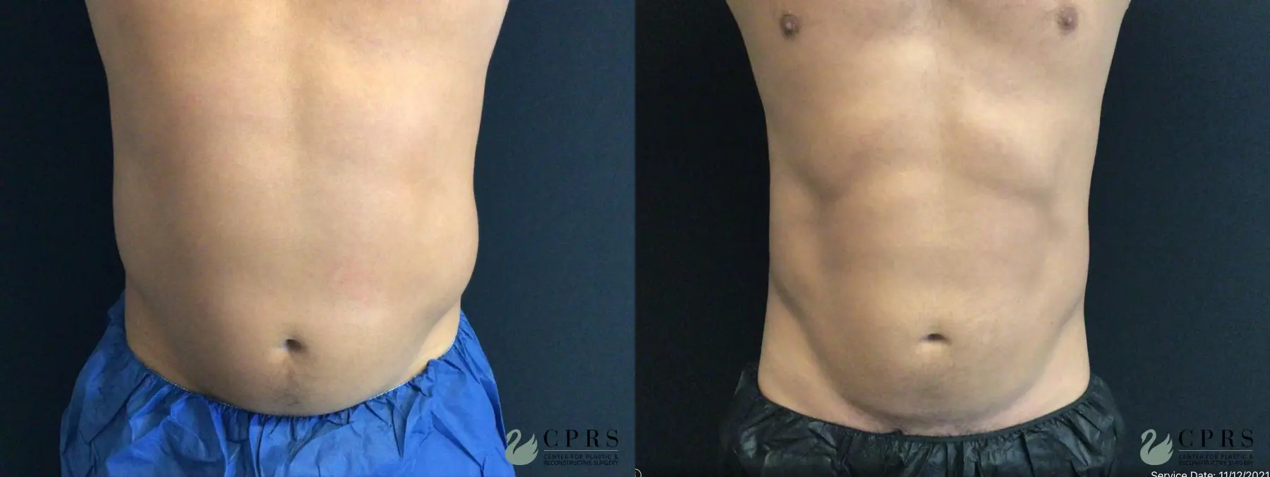 CoolSculpting®: Patient 1 - Before and After  