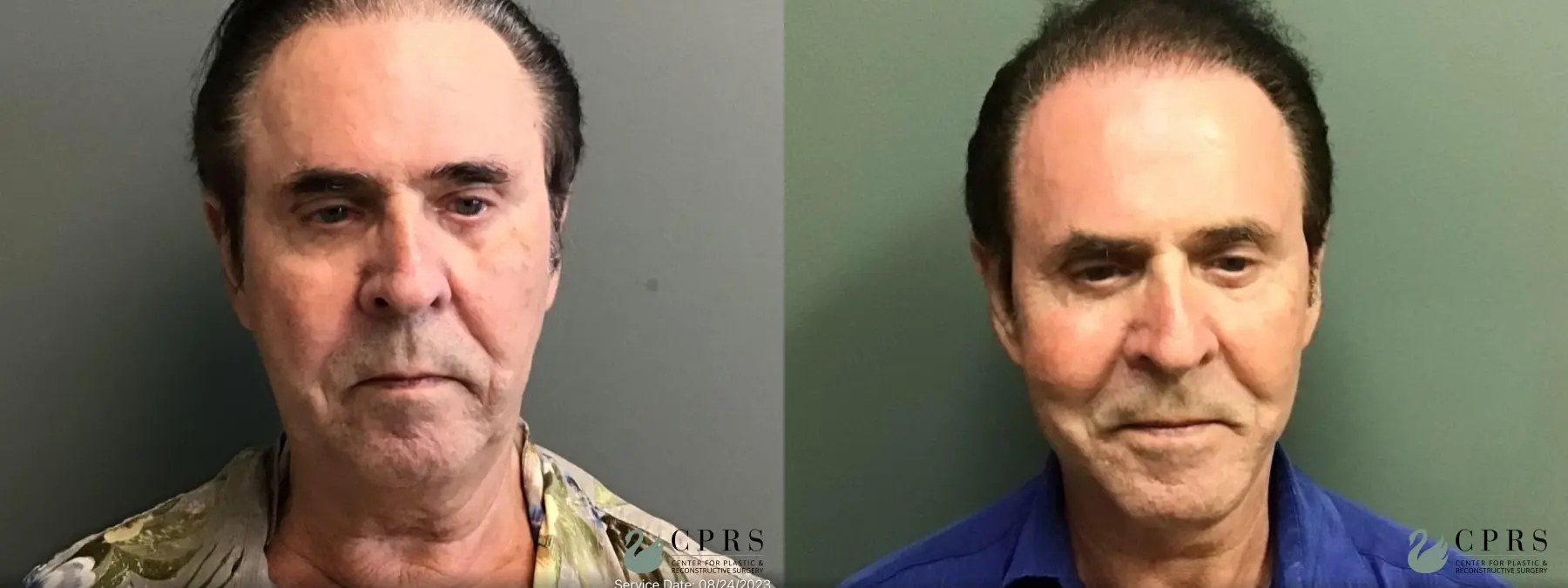 Facelift & Neck Lift: Patient 8 - Before and After  