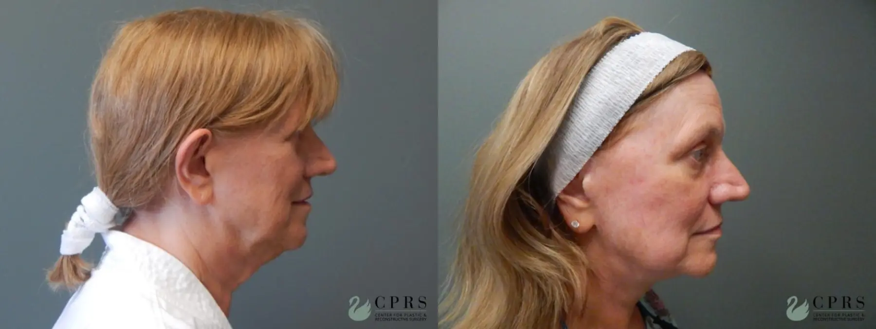 Facelift & Neck Lift: Patient 3 - Before and After  