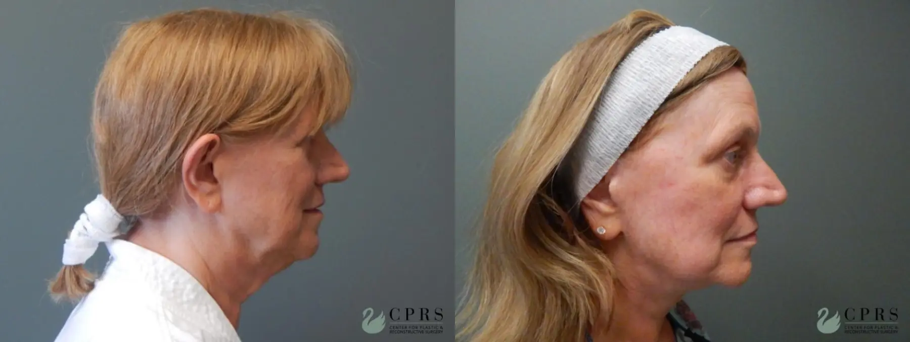 Facelift & Neck Lift: Patient 3 - Before and After  