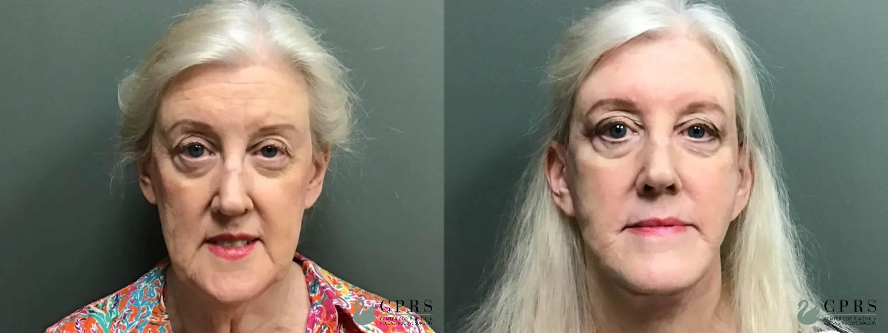 Facelift & Neck Lift: Patient 7 - Before and After  