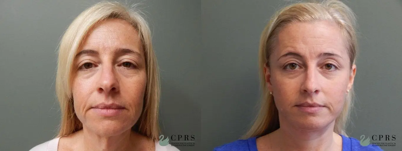 Facelift & Neck Lift: Patient 1 - Before and After  